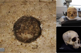 Historic Egyptians Tried to Surgically Deal with Most cancers, Examine Finds