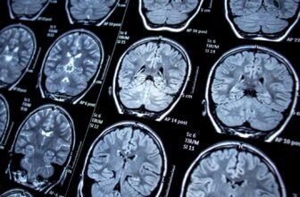 New Examine Hyperlinks Shingles to Cognitive Decline